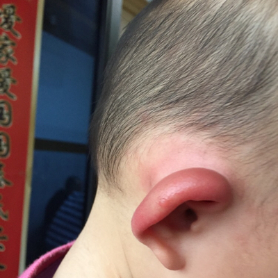 13个月宝宝的耳朵好像被什麼咬了,又红又肿又痒!