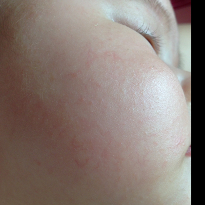 各位姐姐,帮我看看宝宝脸上出的是什麼疹子啊,宝宝刚两个月