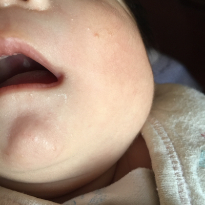 婴儿上颚有白色颗粒图图片