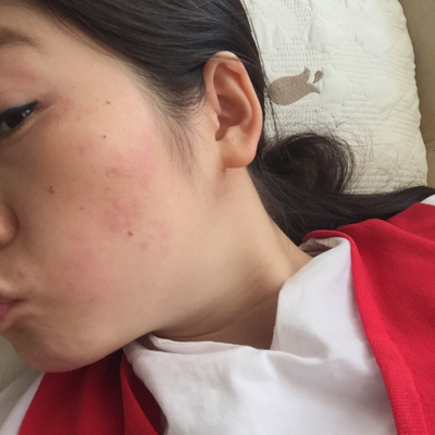 怀孕五个月了,脸颊两边一块一块的红,什麼情况,如何可以改善