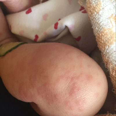 身上好多,看皮肤病说是热痱子,是吗?_宝宝树