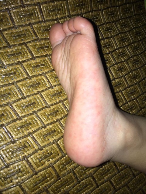 宝妈宝宝脚底下有红点是什么回事