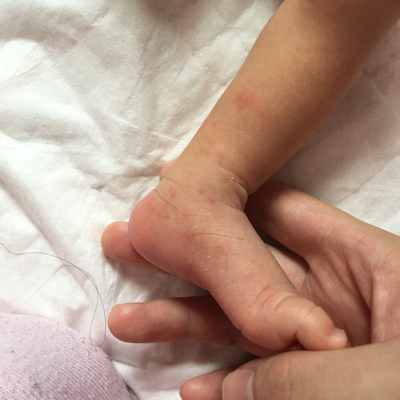 宝宝手脚上发出红点,请问是湿疹还是蚊子咬的