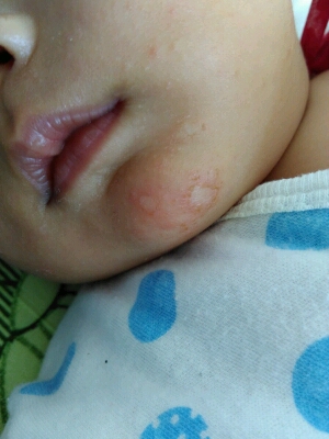 和湿疹差不多,我家宝宝也是这样的,他只要一流口水下巴就开始破皮