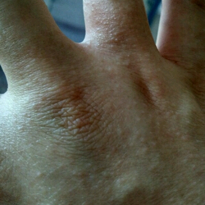 有经验的宝妈们帮忙看看我手上这些密密麻麻的小疙瘩能抹药吗?