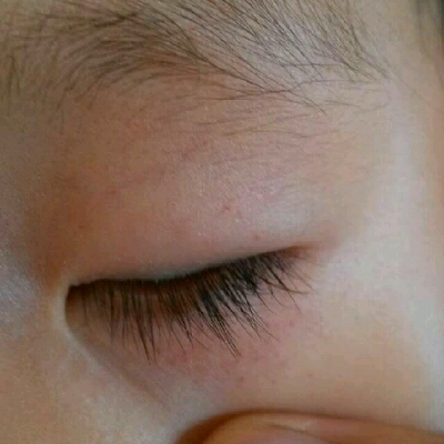 我家大宝两岁四个月了,今天早上发现眼皮底下和上面起了一些小红点,不