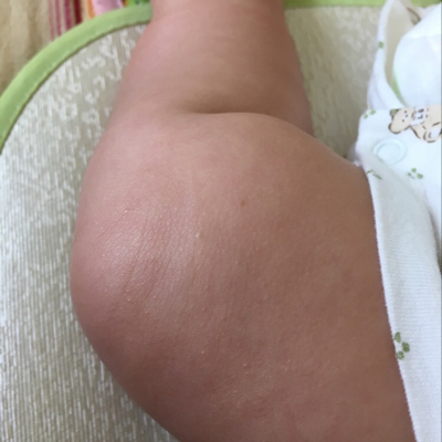 小孩腿上像鸡皮疙瘩怎么办(小孩腿上像鸡皮疙瘩怎么办图片)