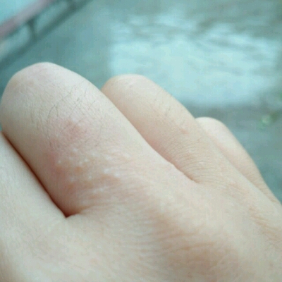 怀孕后右手指缝张出一粒粒小豆豆,痒的狠,这什麼情况啊!能用药不?