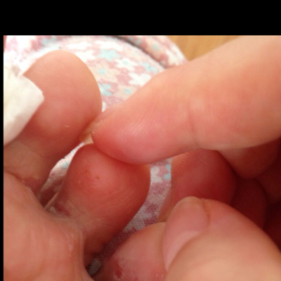 刚生了宝宝四天 脚趾头开始很痒 长水泡 现在都开始有点烂起来了