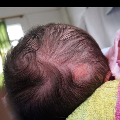 婴儿头顶血管瘤图片图片