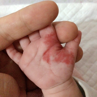 婴儿手掌发红图片图片