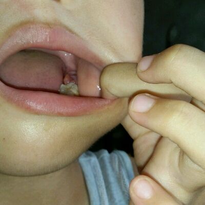 我家宝宝最裏面的牙龈肿大了两三天后,牙龈上面长出了一小块肉芽请问