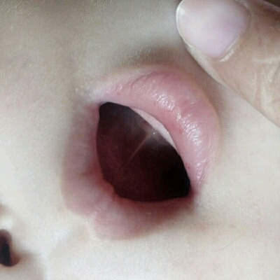 请问宝宝这嘴巴上有一点点血一样的东西,是手足口病吗?