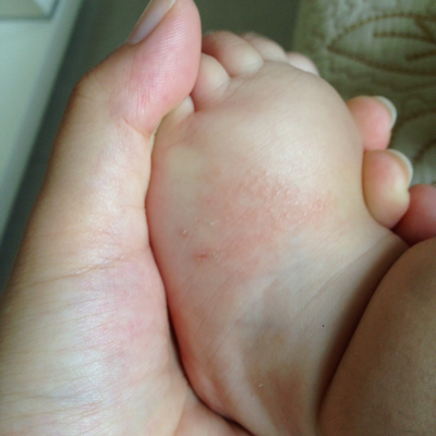 宝宝脚上长湿疹图片图片