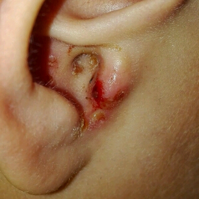 婴儿中耳炎初期图片图片