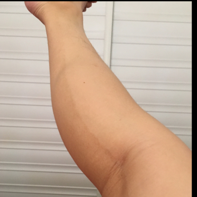 大腿后面有一道深色的