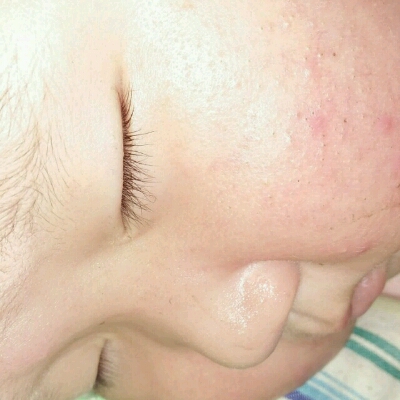 宝宝脸上长了痤疮也叫黑头粉刺,用什麼药摸摸效果会好些呢?急急急
