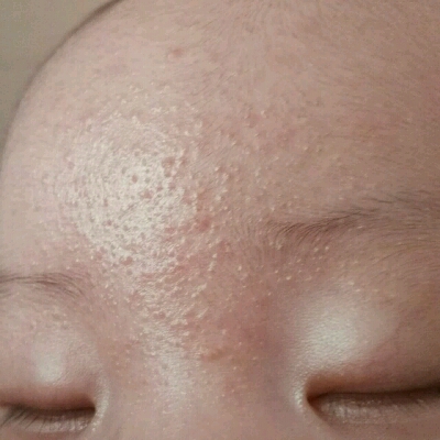 宝宝脸上长脂肪粒图片图片