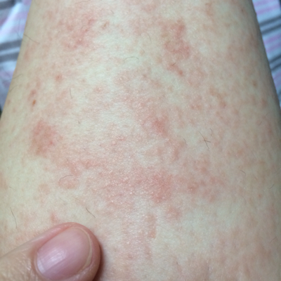 大腿湿疹症状图片图片