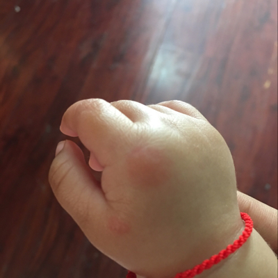 宝宝手上起了红包 裏面还有小泡泡 这是被蚊子咬了吗