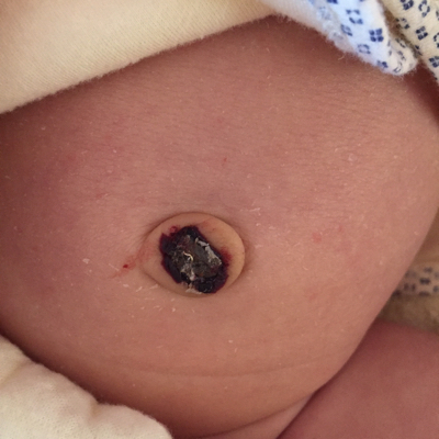 满月婴儿肚脐正常图图片