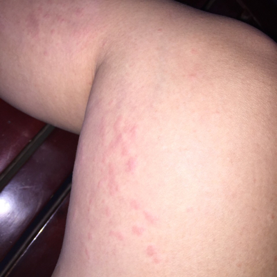 有得妊娠皮炎治好的宝妈吗,晚上实在痒得发疯了