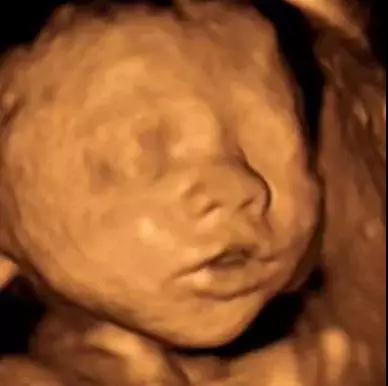 想知道宝宝是否健康 超声影像(四维彩超) 针对22—28周之间的宝妈